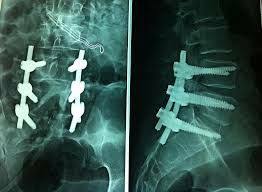 /Anterior cervical discectomy and fusion (ACDF) 